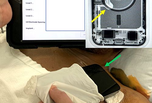 Un iPhone 12 peut arrêter un stimulateur cardiaque simplement en étant à proximité