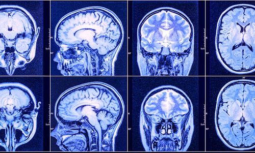 Un nouveau traitement prometteur contre le glioblastome, le cancer du cerveau le plus fréquent et agressif