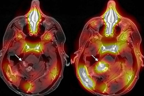 Première mondiale : une méthode pour traiter le cancer du cerveau en franchissant la barrière hémato-encéphalique