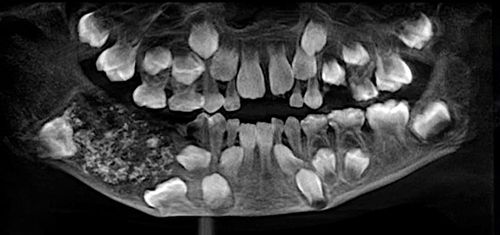 Des dentistes ont retiré plus de 500 dents de la bouche d'un garçon de 7 ans