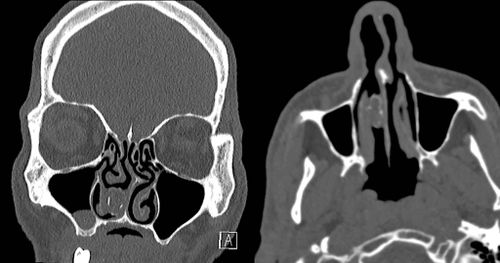 Cet homme a caché de l'herbe dans son nez : elle est restée coincée pendant 18 ans...