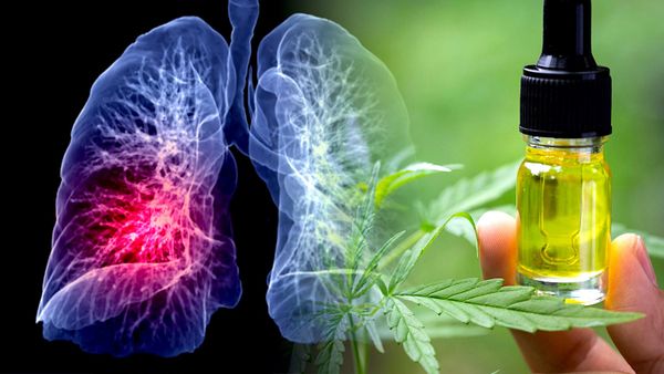 Une femme s'auto-traitant uniquement avec du CBD voit la taille de sa tumeur régresser de 76%