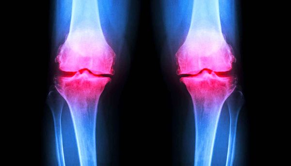 Un hydrogel injectable pour régénérer le cartilage endommagé des articulations