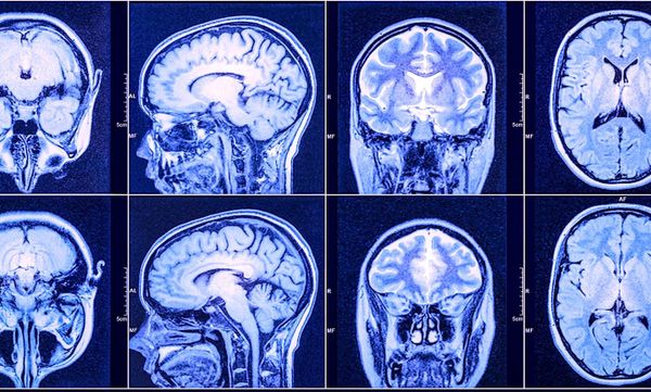 Un nouveau traitement prometteur contre le glioblastome, le cancer du cerveau le plus fréquent et agressif