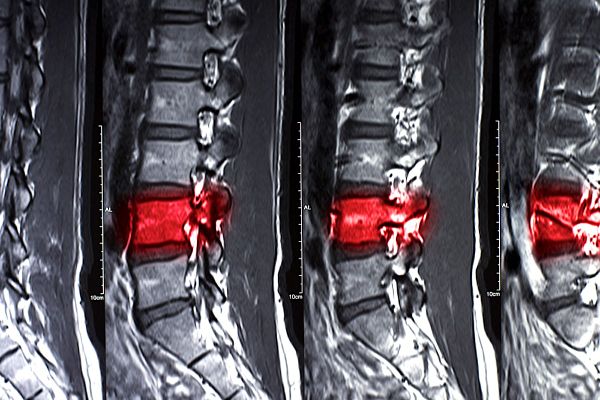 Réparer la moelle épinière en utilisant les cellules souches des patients