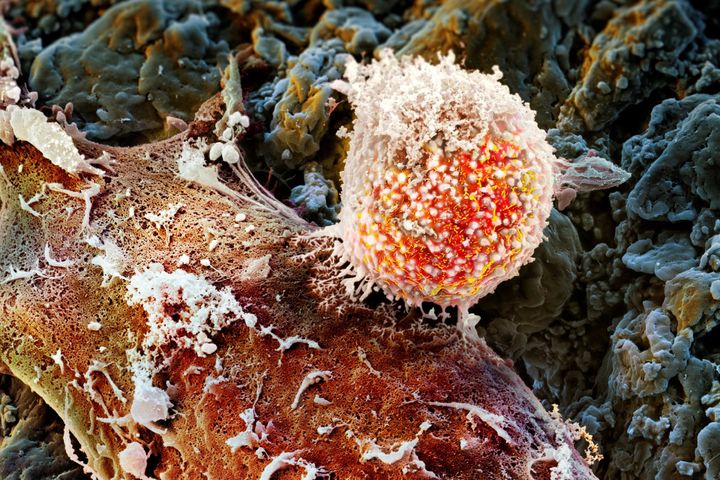 KSB: Hoffnung für Menschen mit Lungenkrebs